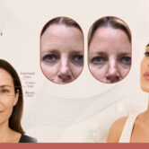 Forehead and Frown Line Botox in New Jersey